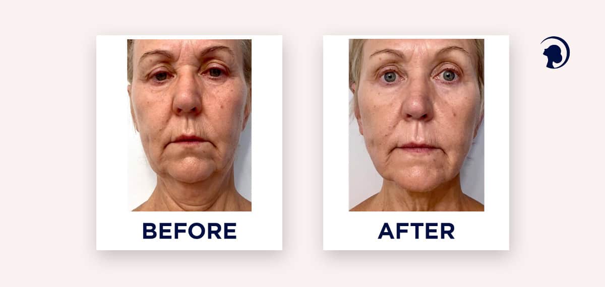 Introducing Face Yoga Challenge: The 15-Day Wrinkle Away!