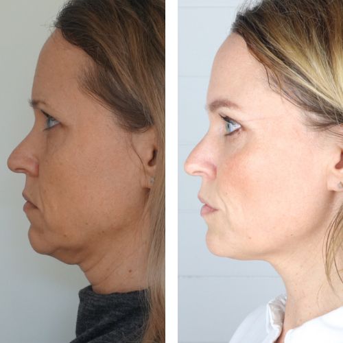 Woman before and after face yoga exercises for neck and jawline